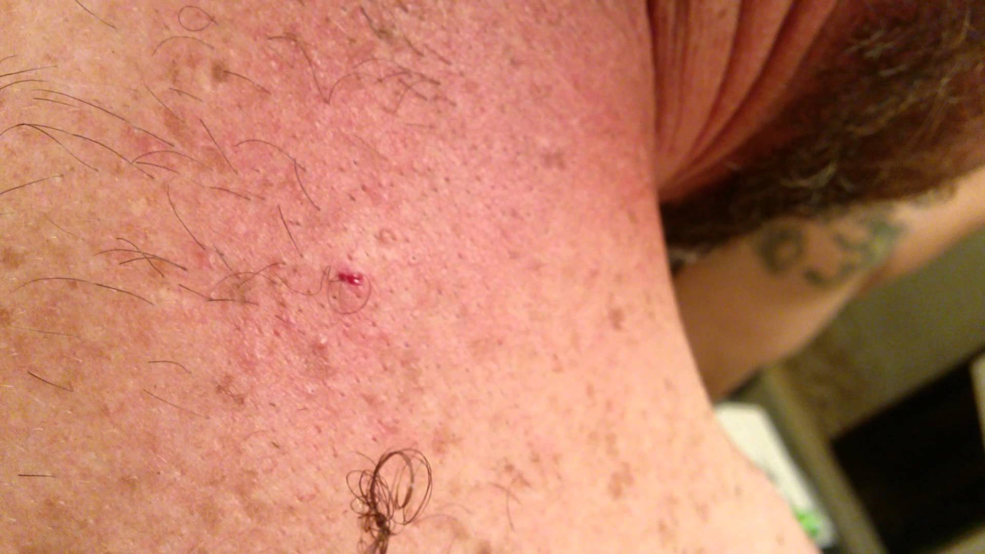 Can an ingrown hair go away on its own? 